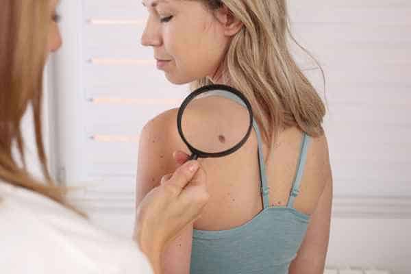 What Are Traditional Skin Lesion Removal Methods Littlehampton?