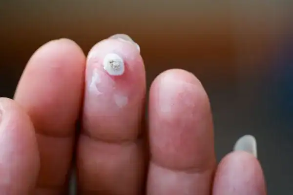 Image of white wart before cryopen treatment Littlehampton
