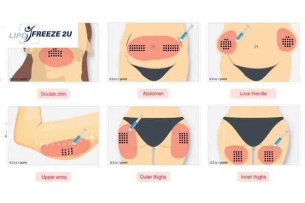 Benefits of Choosing Aqualyx for Fat Reduction Littlehampton