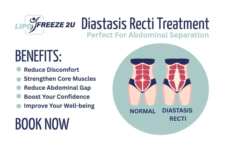 Benefits of body toning treatment Littlehampton for Diastasis recti