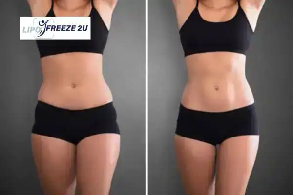 How Can LIPO FREEZE 2U Support Your Post-Pregnancy Body Recovery Littlehampton?
