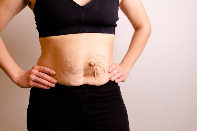 Is Surgery Really the Only Way to Repair Diastasis Recti Littlehampton?