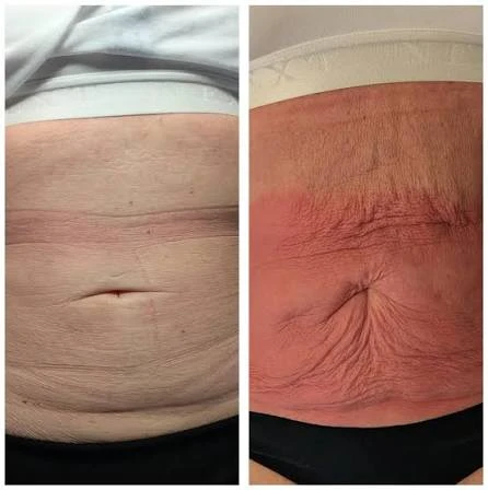 How Does RF Microneedling Improve Crepey, Thin and Uneven Skin Texture Littlehampton?