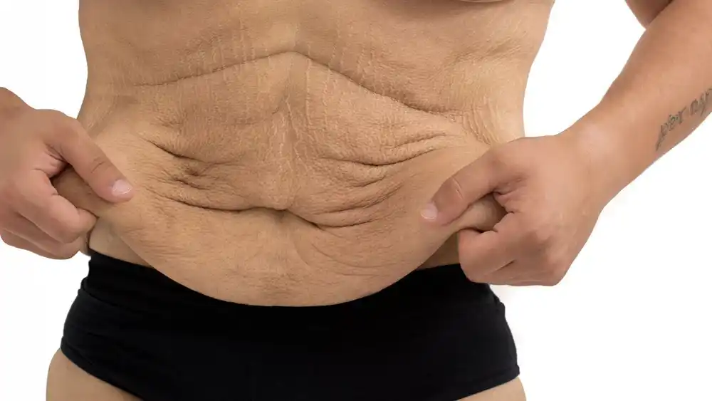Why Does Weight Loss Medication Leave Some People With Loose or Sagging Skin Littlehampton?